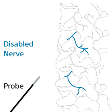 Back Pain Spreading to Legs