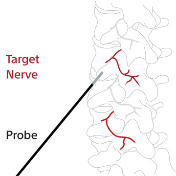 Back Pain Spreading to Legs